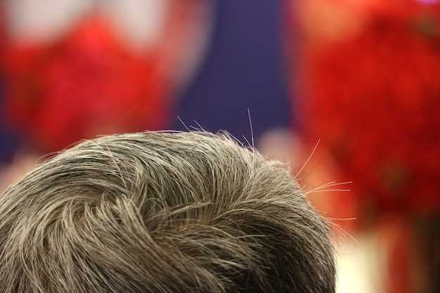 Symptoms of Diffuse Unpatterned Alopecia