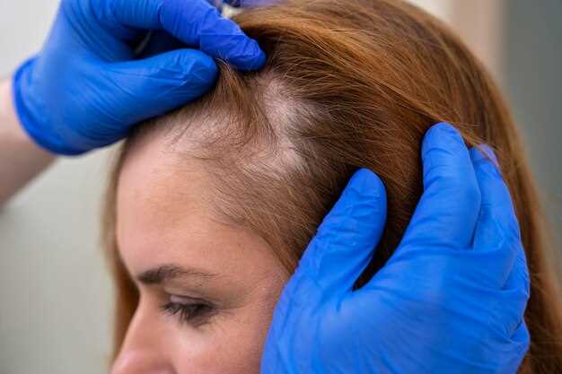 Synthroid for Hair Loss